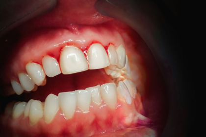 Why Bleeding Gums Should Never Be Ignored Even If They Don't Hurt