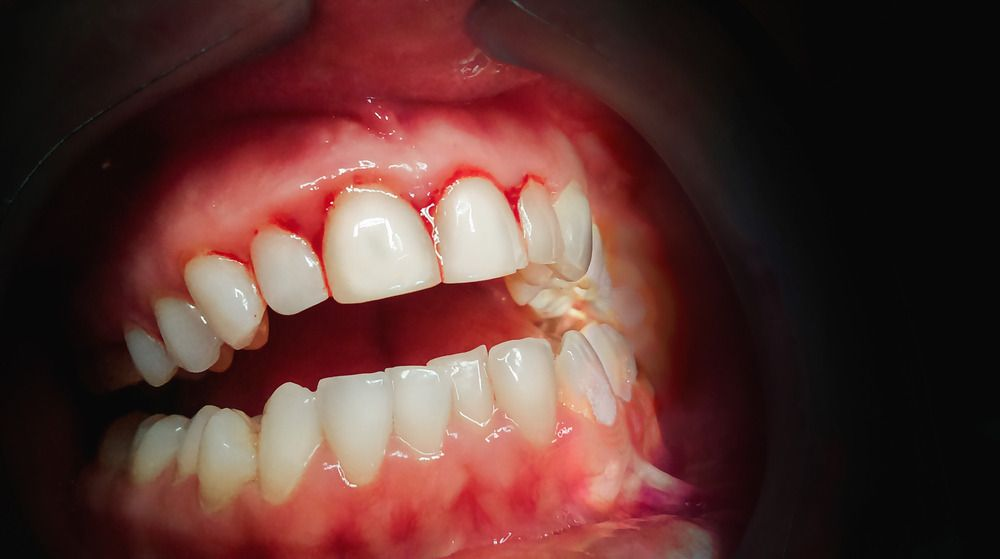 Why Bleeding Gums Should Never Be Ignored Even If They Don't Hurt
