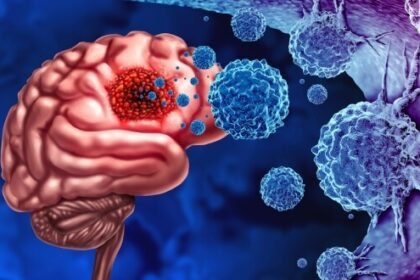 Understanding Glioblastoma Treatment Options, Supportive Care and the Role of Evidence-Based Ayurveda