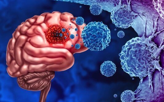 Understanding Glioblastoma Treatment Options, Supportive Care and the Role of Evidence-Based Ayurveda